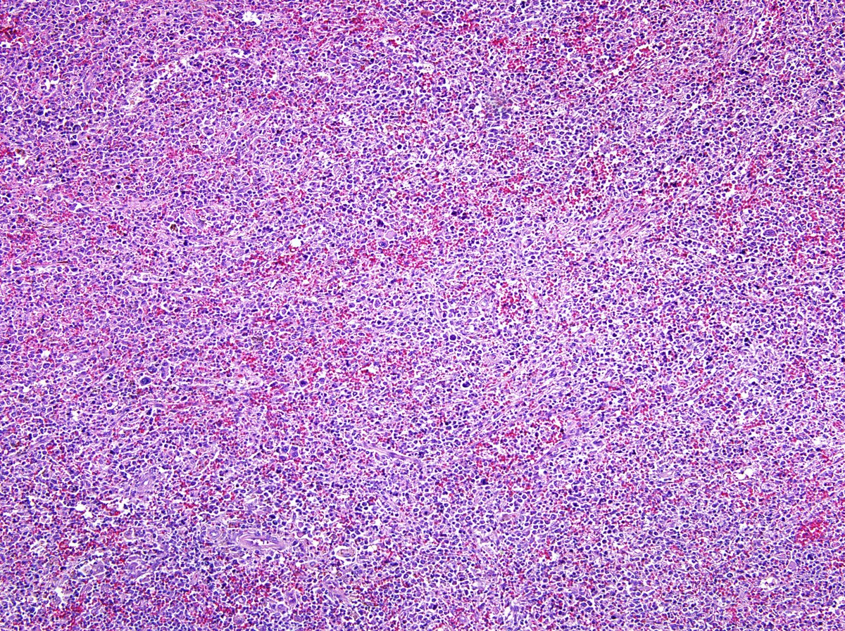 Spleen, splenectomy (1998, submitted) showed MDS in spleen with increased blasts and immature myeloid cells consistent with early acute transformation. Low power H&E image showed markedly expanded red pulp and atrophic white pulp.